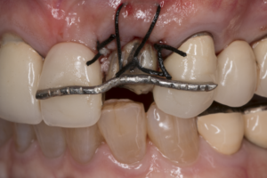 歯の再植
