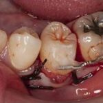 歯の移植1