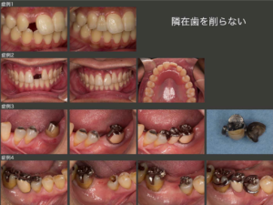 歯を削らない １ 隣在歯を削らない