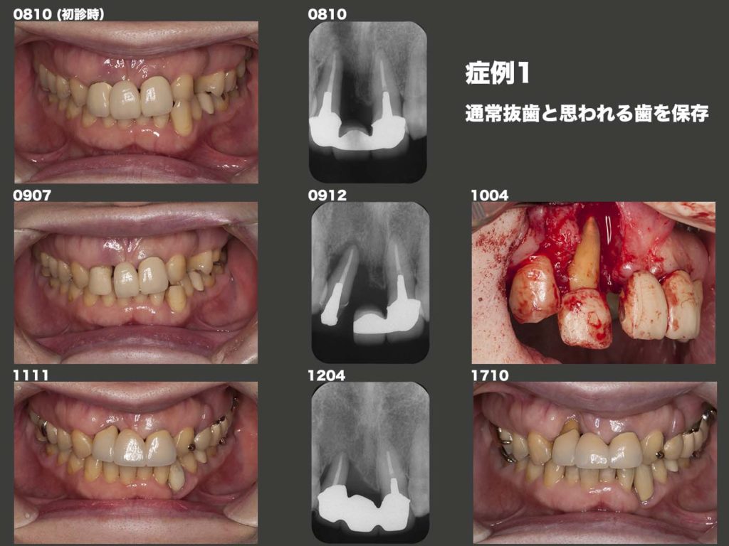通常抜歯と思われる歯を保存１