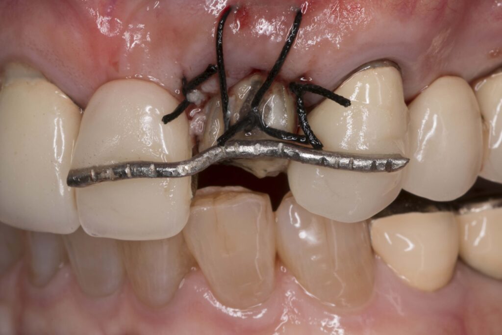 歯 の 再 植